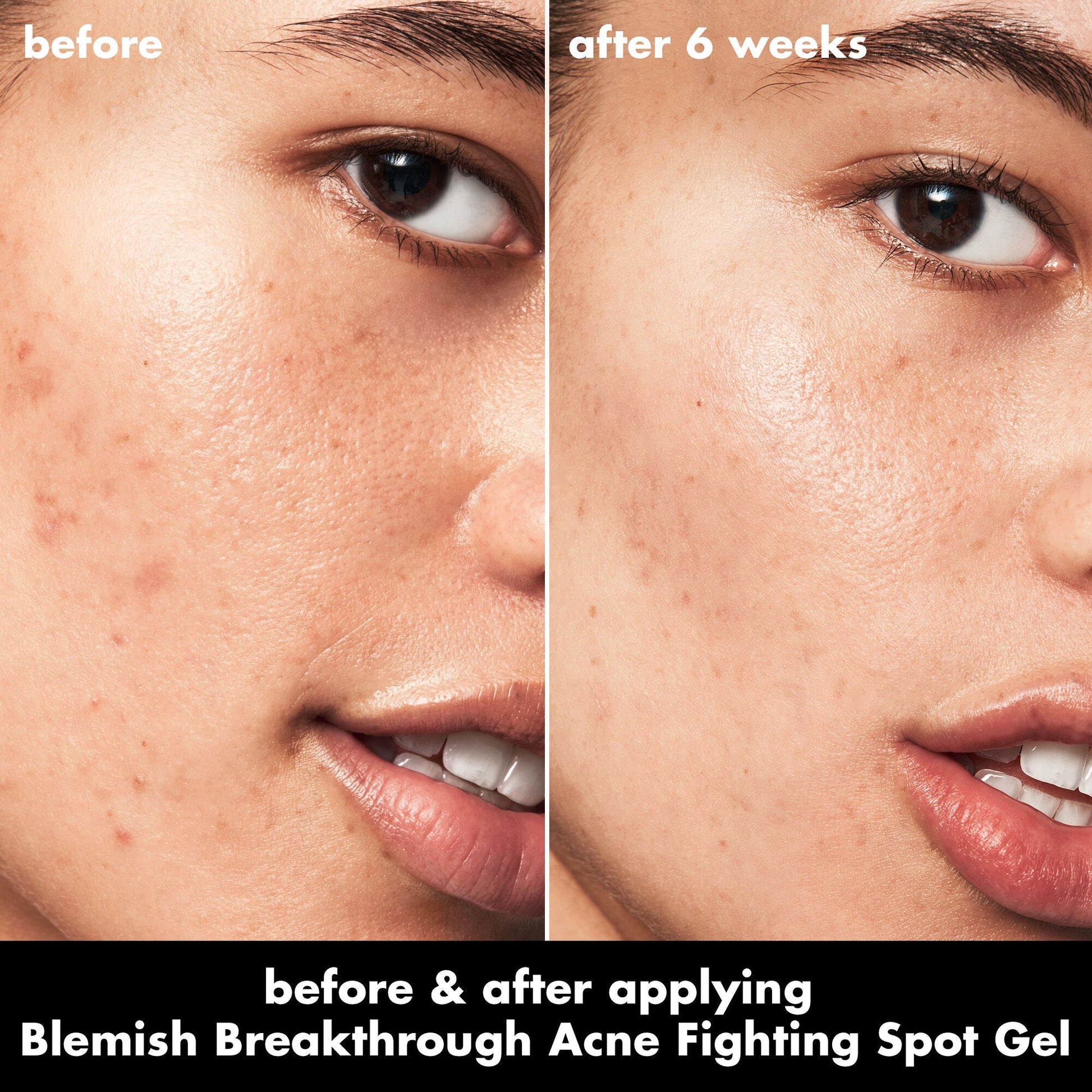blemish-breakthrough-acne-fighting-spot-gel-q2 0326_EDU_BB_SpotGel_BA_ISABELLA.jpg