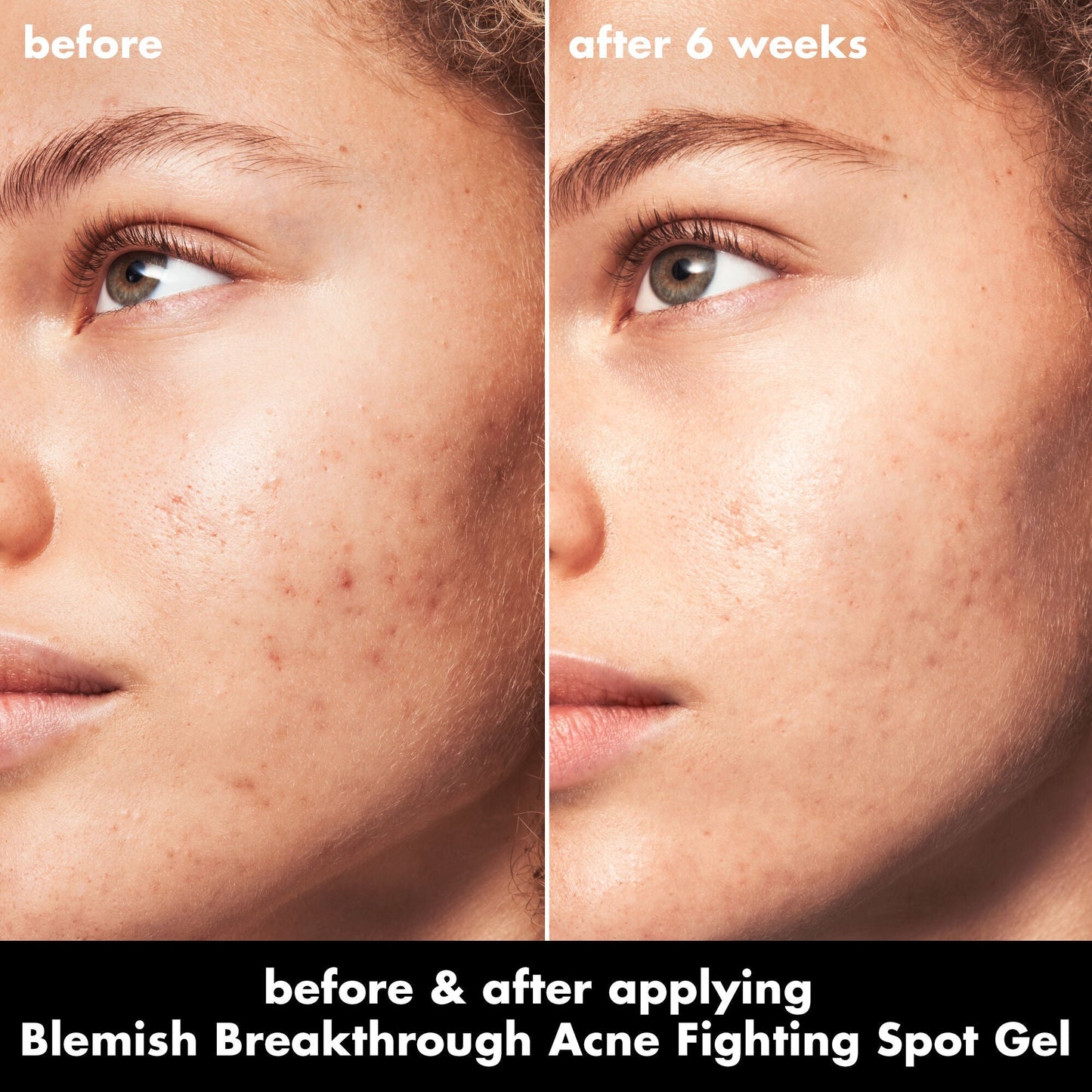 blemish-breakthrough-acne-fighting-spot-gel-q2 0326_EDU_BB_SpotGel_BA_MARLEY.jpg