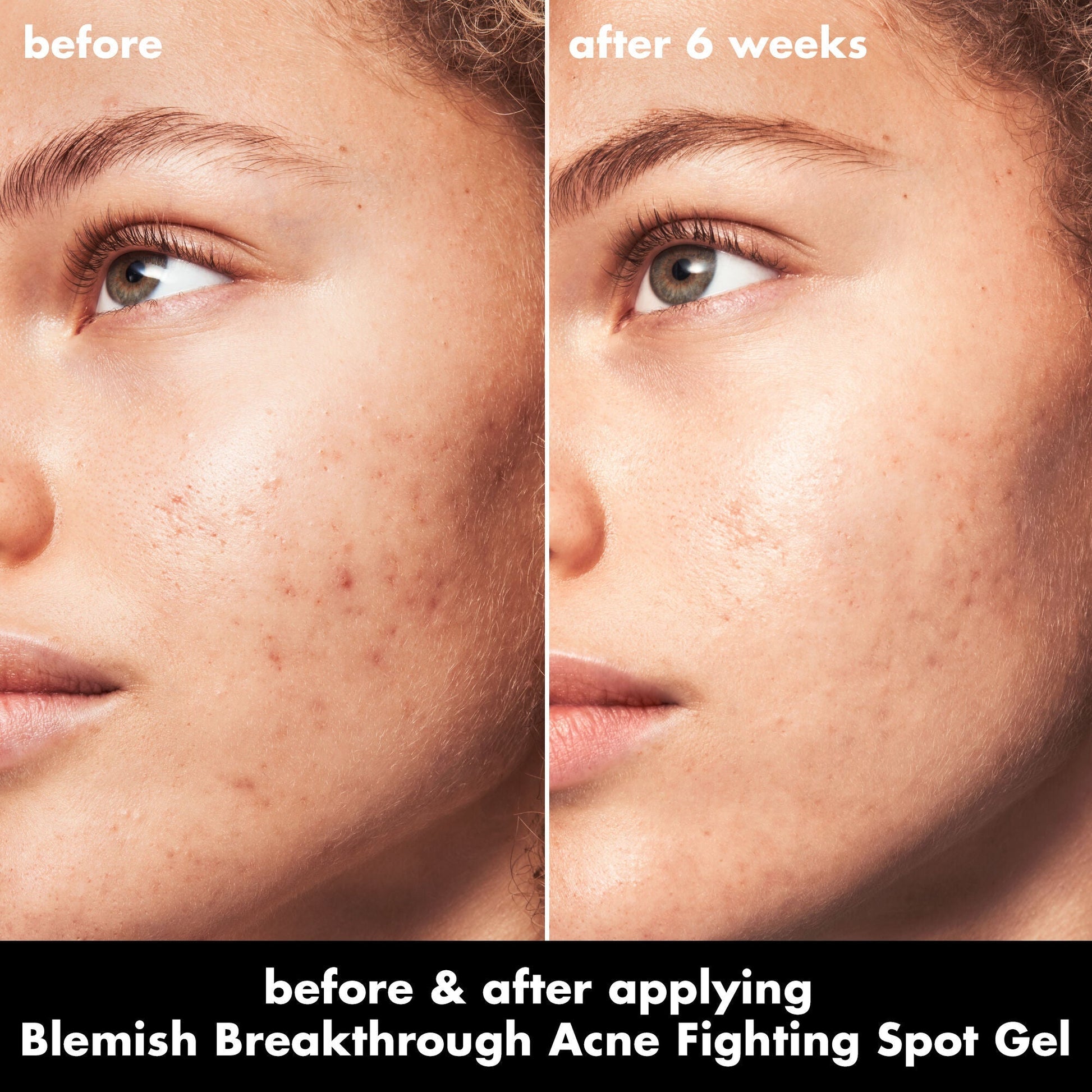 blemish-breakthrough-acne-fighting-spot-gel-q2 0326_EDU_BB_SpotGel_BA_MARLEY.jpg