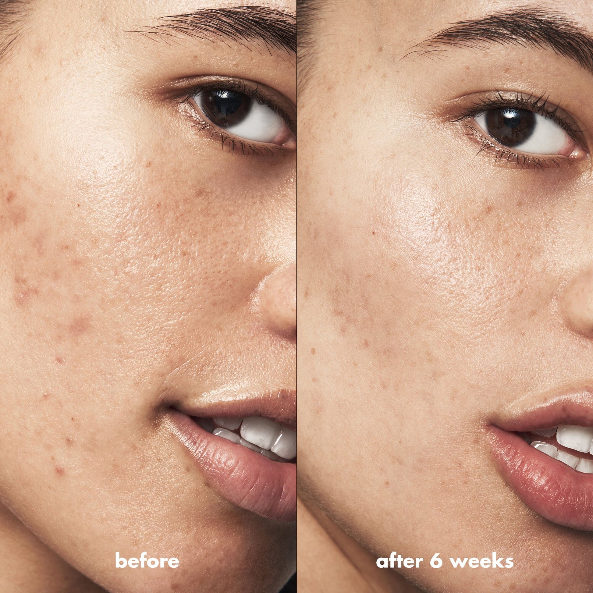 blemish-breakthrough-blemish-control-basics-kit-u2 Acne_PDP_Isabella_Before_After_0fcb9356-ae60-4e94-8953-6b1b2219dc49.jpg