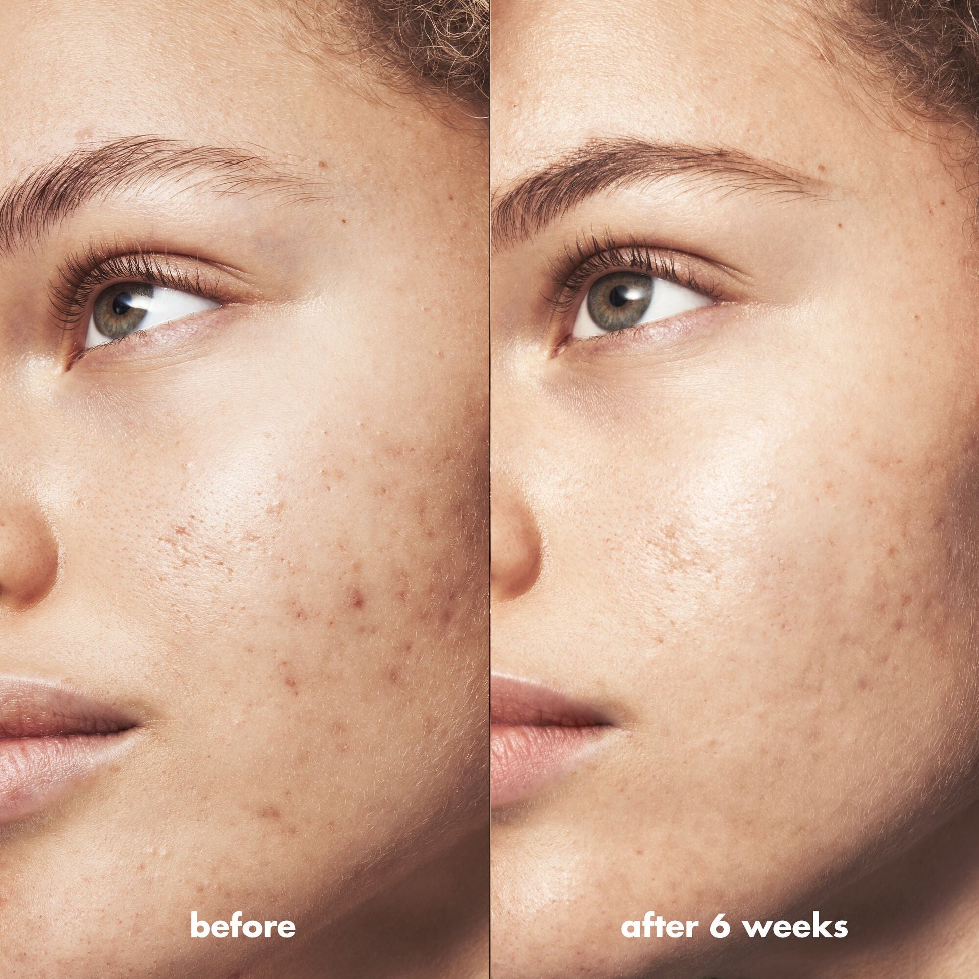 blemish-breakthrough-acne-calming-water-cream-o6 Acne_PDP_Marley_Before_After_be0f6ee7-ce12-4695-83d7-5ec5f0498e19.jpg